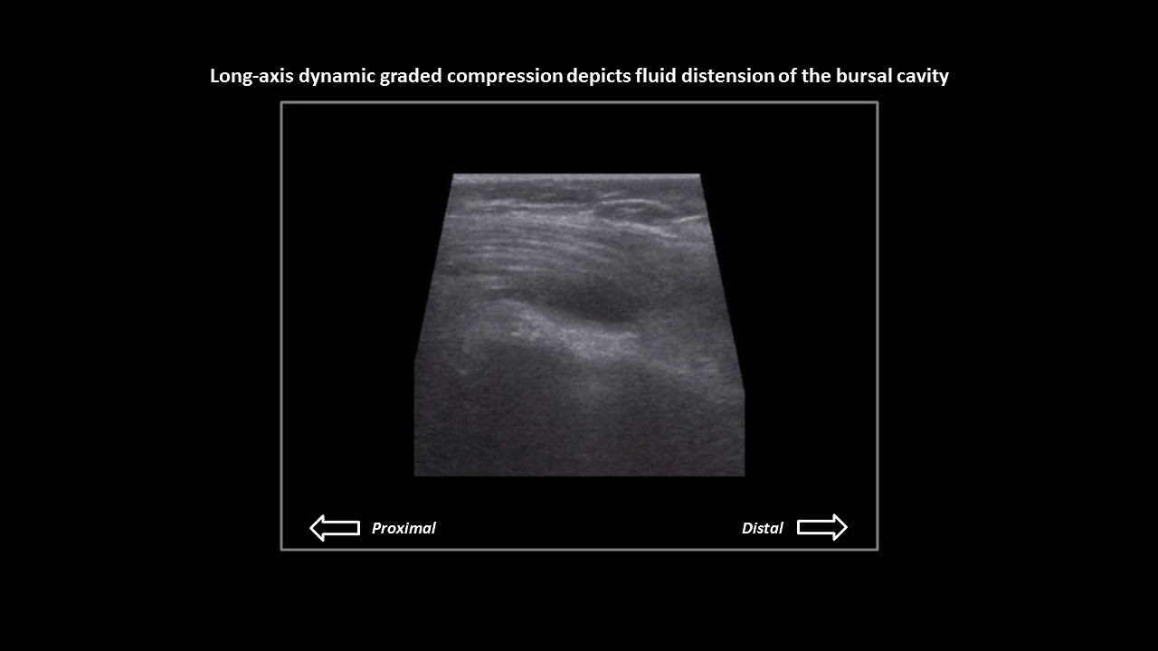 Subacromial-subdeltoid bursitis on shoulder ultrasound