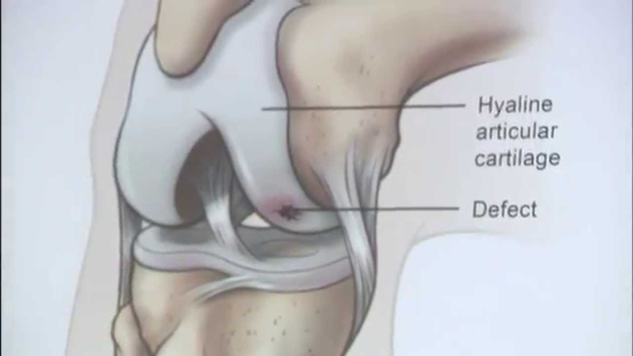 Could the NeoCart Implant Offer an Alternative to Microfracture Surgery?