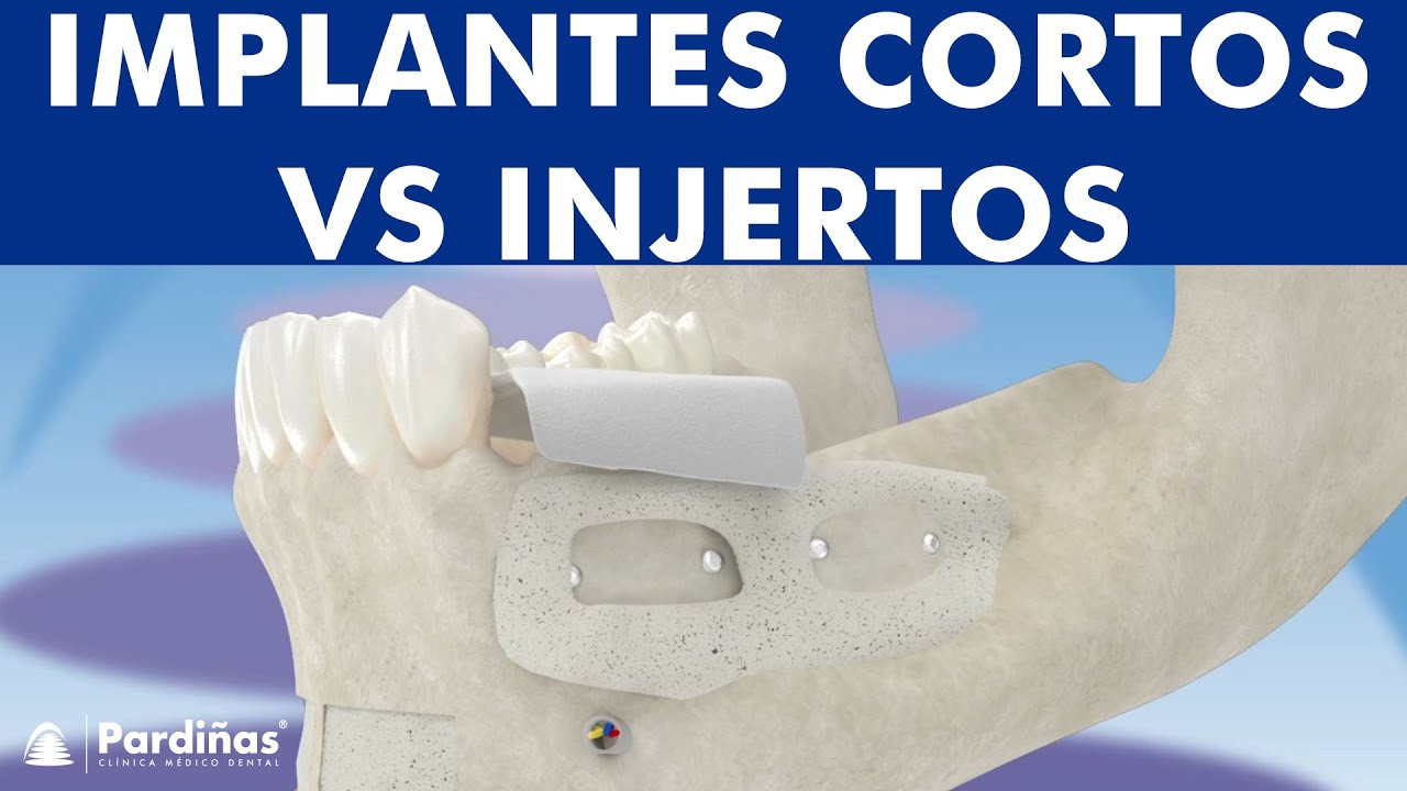 Los implantes cortos VS el aumento óseo mandibular ©