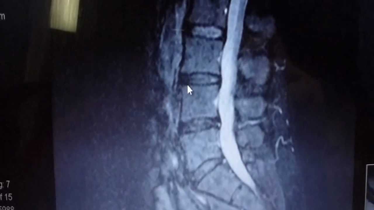 Escondido Chiropractor shows Disc Herniation Fixed with Spinal Decompression Therapy.  MRI Proves