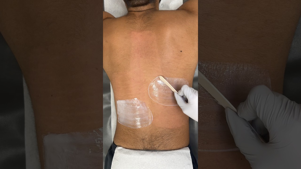 Satisfying men&rsquo;s full back wax #waxing #brazillianwax #hairremoval #skincare #hairremovalproducts