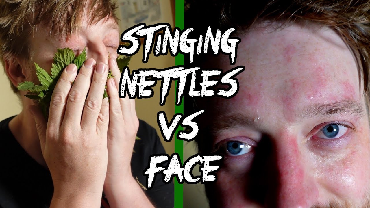 Stinging Nettles VS Face