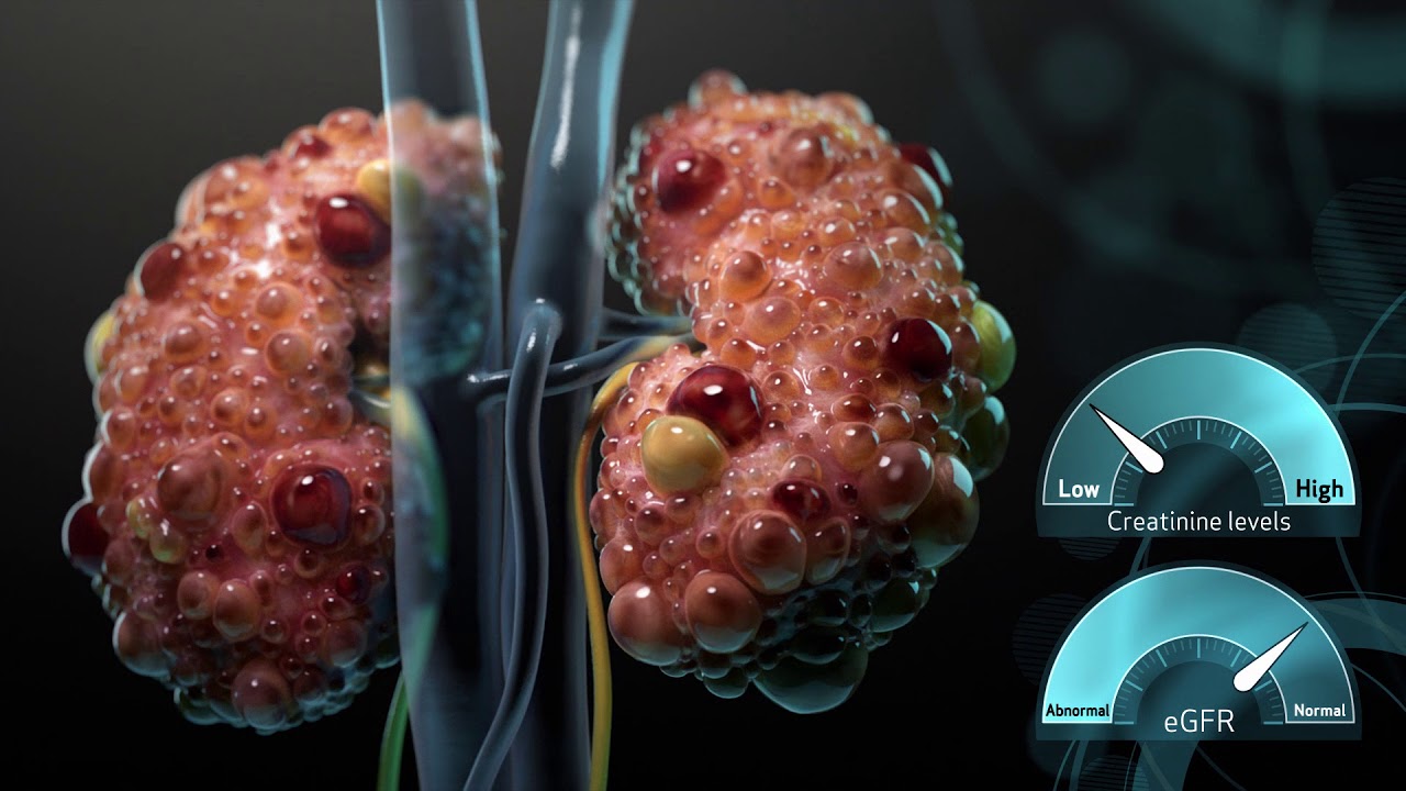ADPKD Mechanism of Disease Video for Health Care Providers