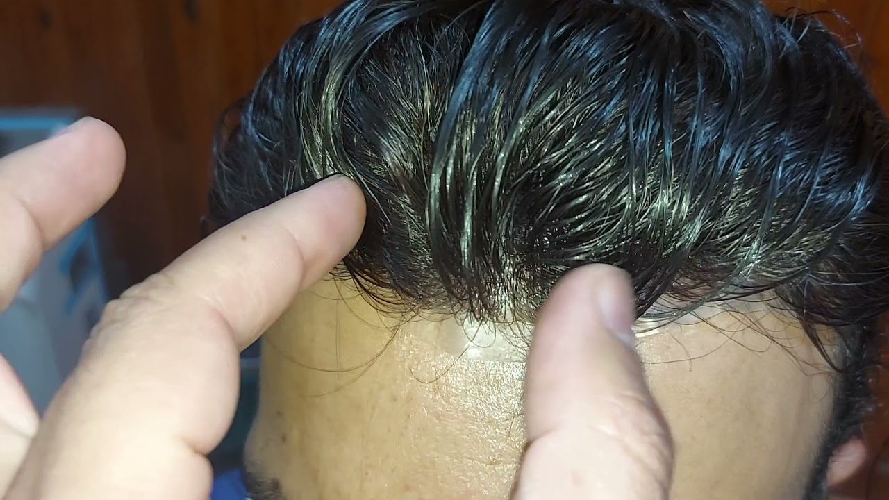 للرجال و السيدات حل هايل لمقدمة الشعر الخفيفة او التالفة  01208274340