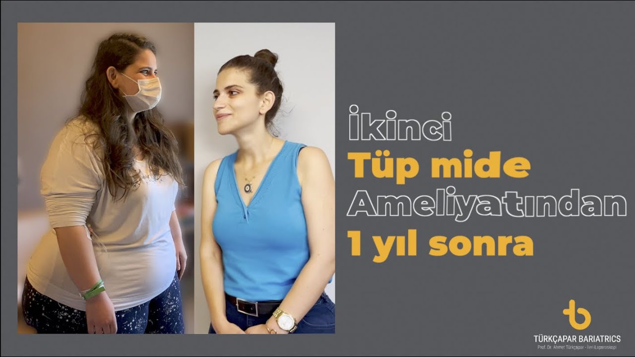 İkinci Tüp Mide (Re-Sleeve) Ameliyatından 1 Yıl Sonra