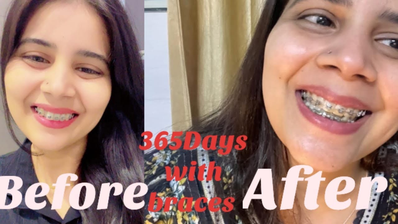 12 Months 12 days braces journey #viral #dentist #trending #dentalcare #toptrending #youtube 