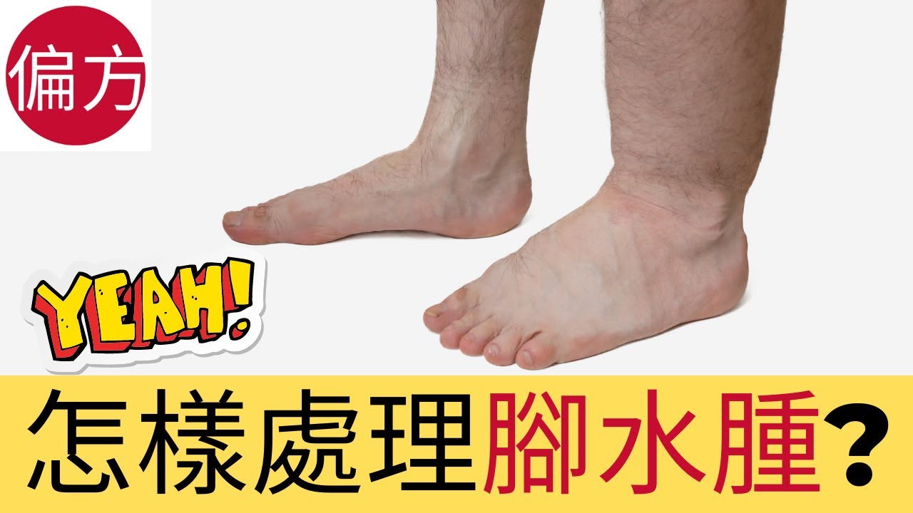 腳水腫怎麼辦?｜五招消除腳水腫