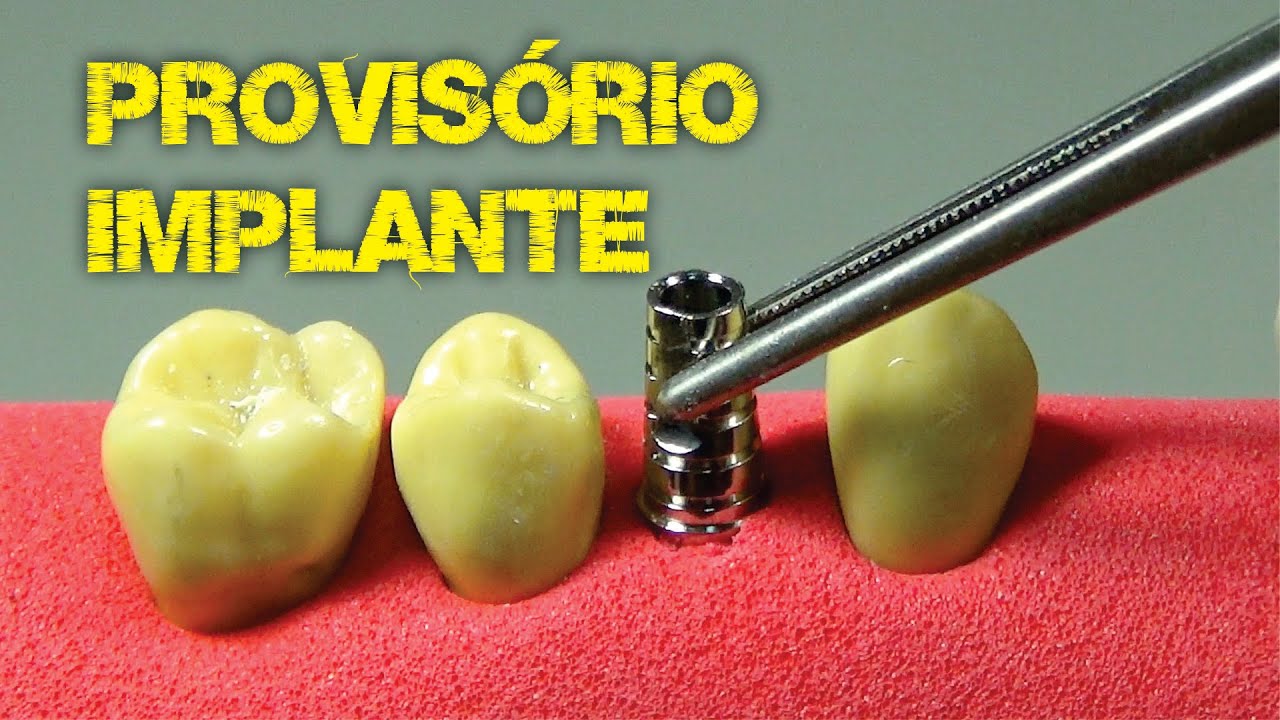 PROVISÓRIO para IMPLANTES DENTÁRIOS