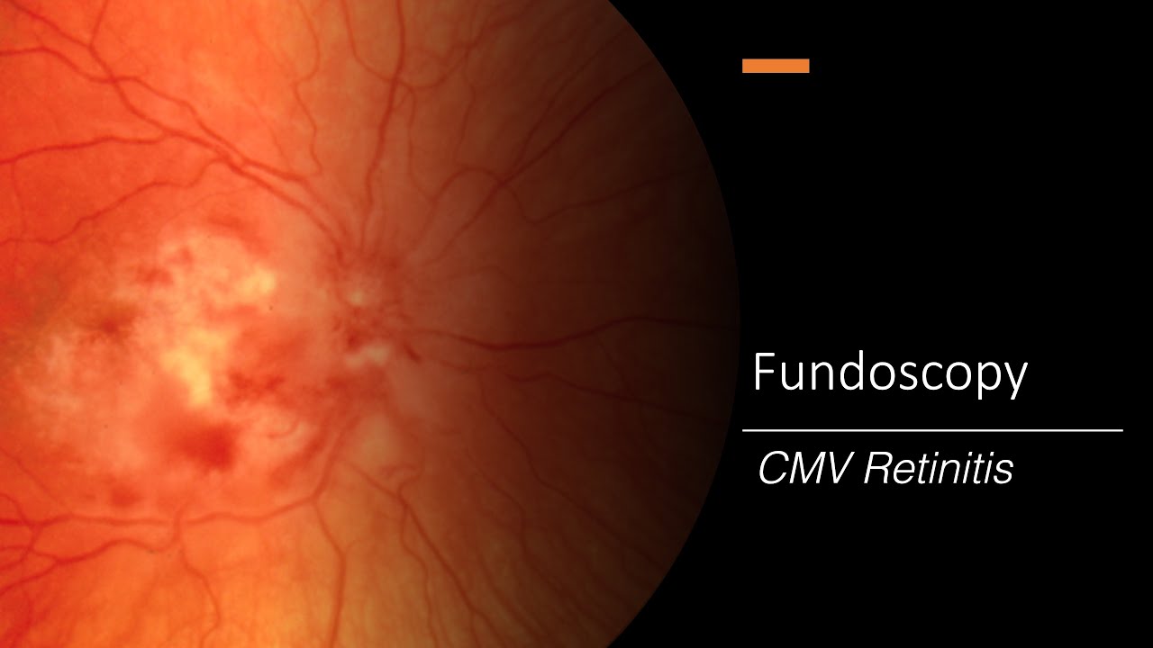 CMV Retinitis: Fundoscopy