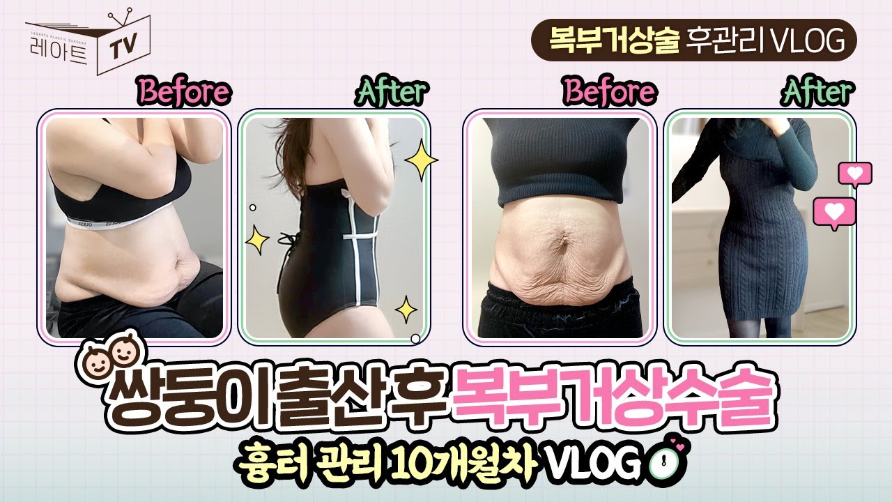 [복부거상수술] 10개월 후 갑자기 켈로이드?? 후관리와 흉터 변화 비교🤓 [레아트성형외과]