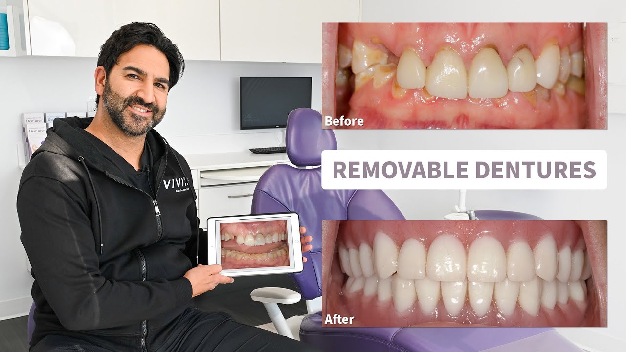 From Failing Teeth to a Confident Smile: Removable Implant-Supported Overdenture Case Review