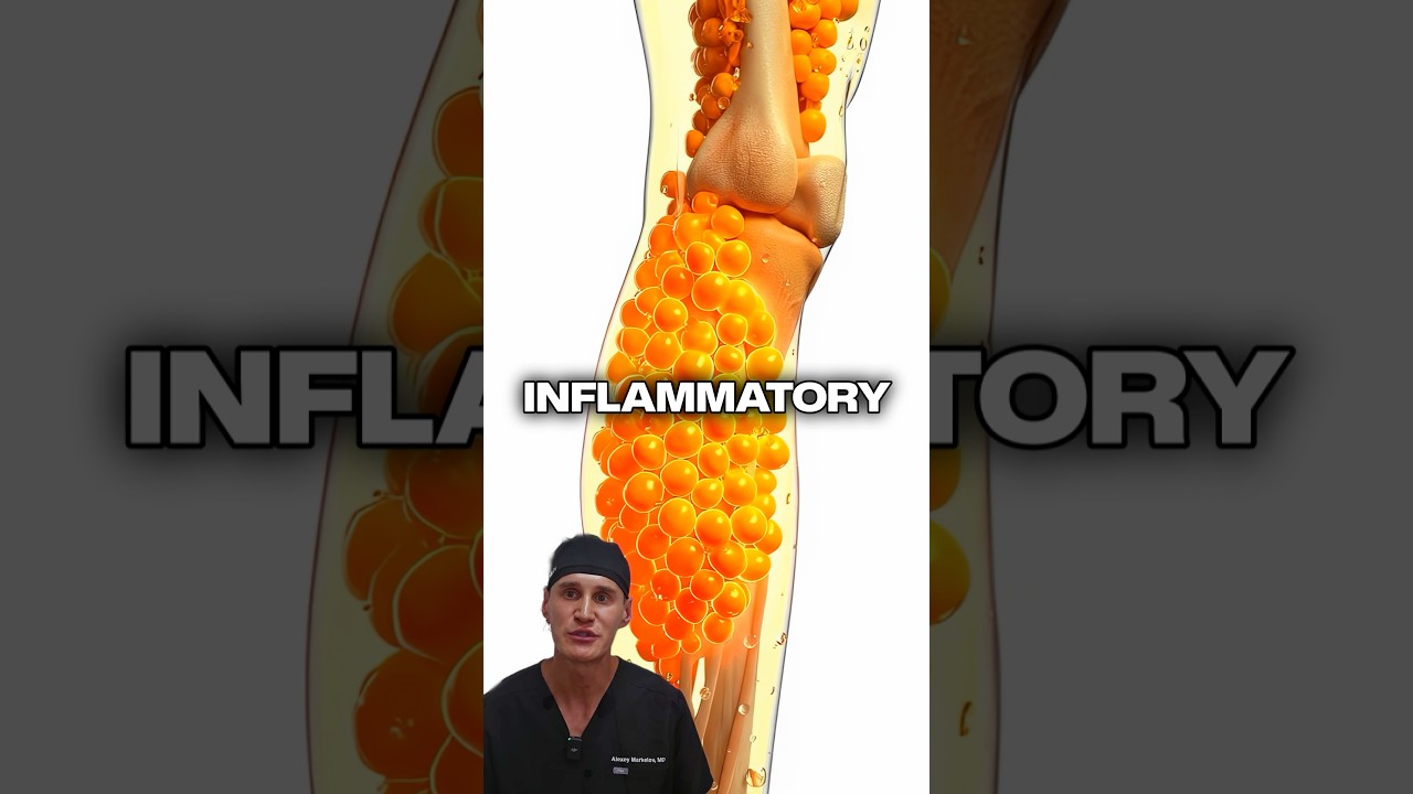 The Truth About Lipedema Pain