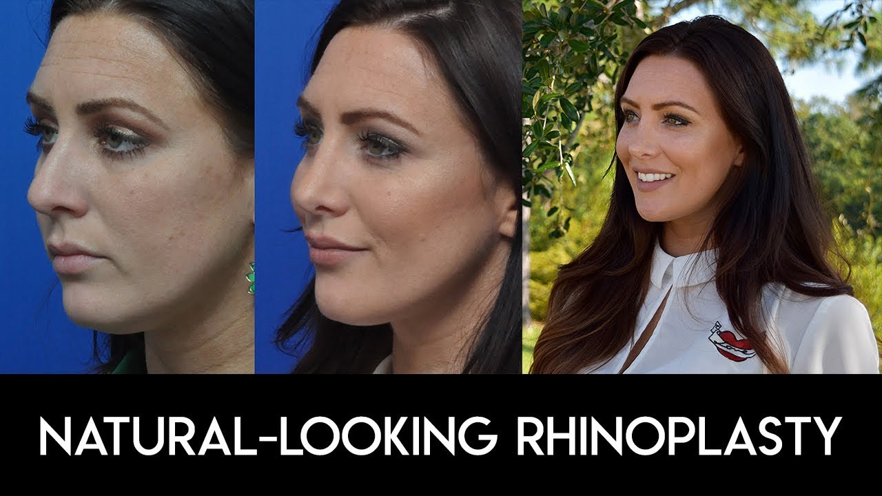 Natural Looking Rhinoplasty