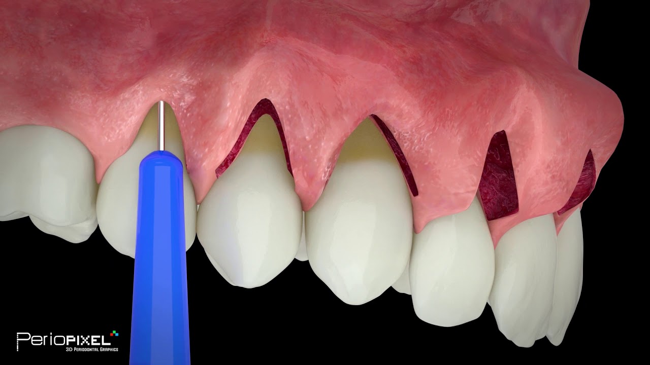 Avance vídeo completo "Cirugía múltiples recesiones gingivales adyacentes mediante itc en túnel"