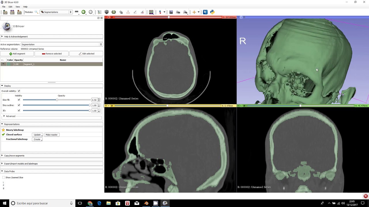 Slicer3d vs. Invesalius