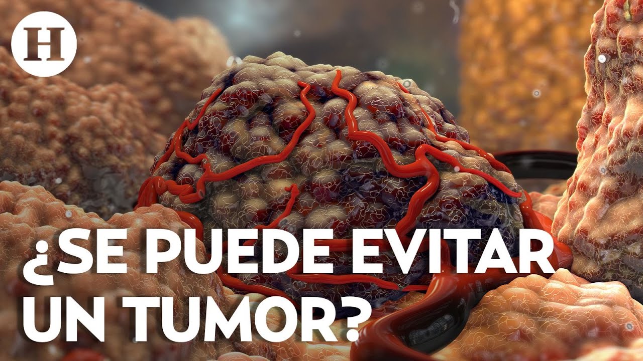 ¡No fumar y no tomar! Hábitos relacionados con la aparición de tumores malignos; alerta doctor