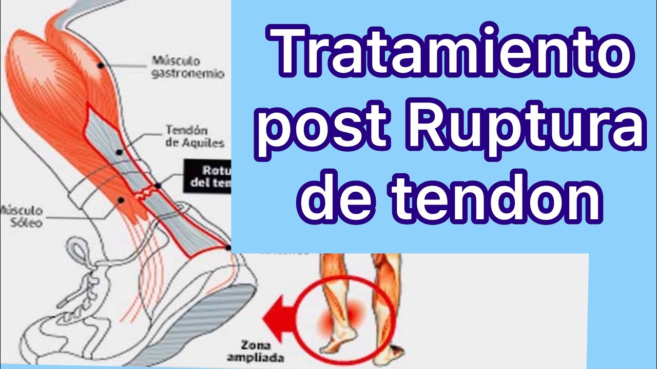 Como tratar una RUPTURA de tendón de aquiles en fase post-operatoria