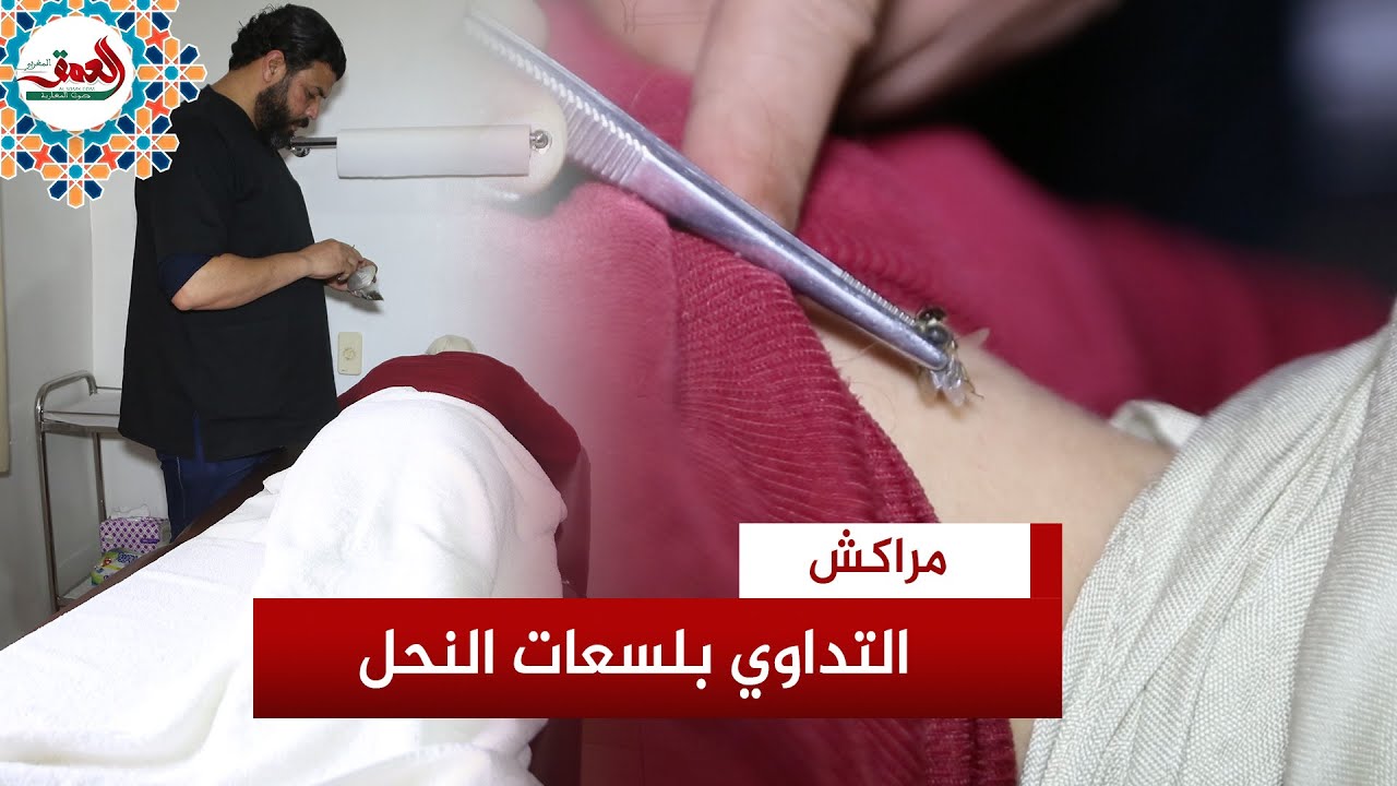العلاج بلسعات النحل..أخصائي يكشف أهميته وفوائده ودواعي استعماله