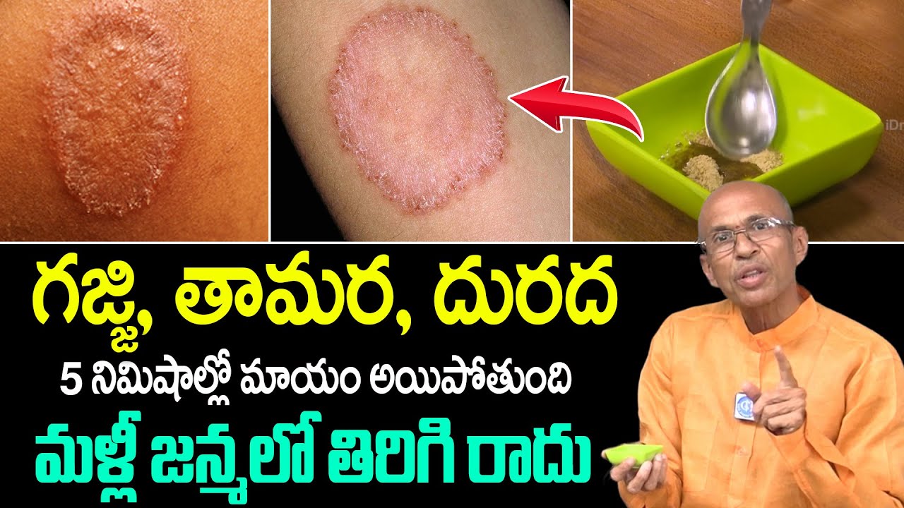 Madhusudhan Sharma | గజ్జి, తామర, దురద 5 నిమిషాల్లో మాయం అయిపోతుంది | SkinCare | iDream Health Talks