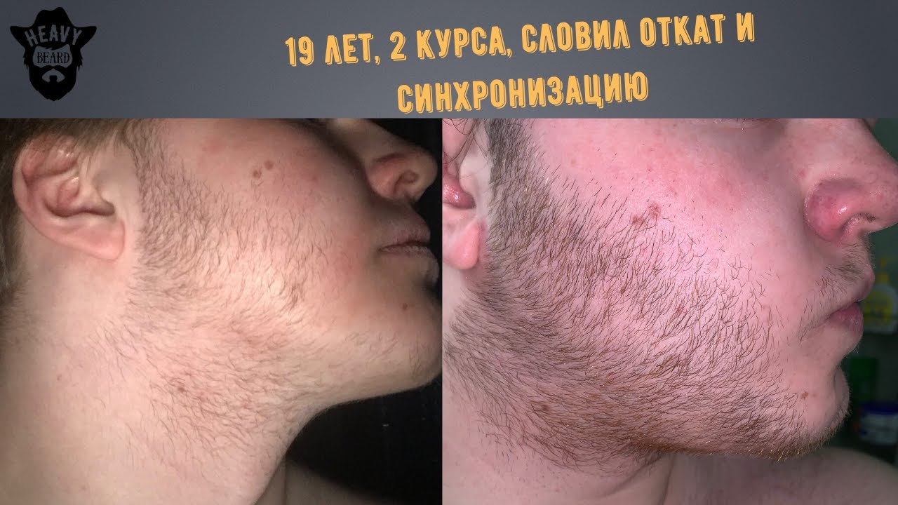 В 19 лет откатило после 3 месяцев минокса! Урок как не надо делать.