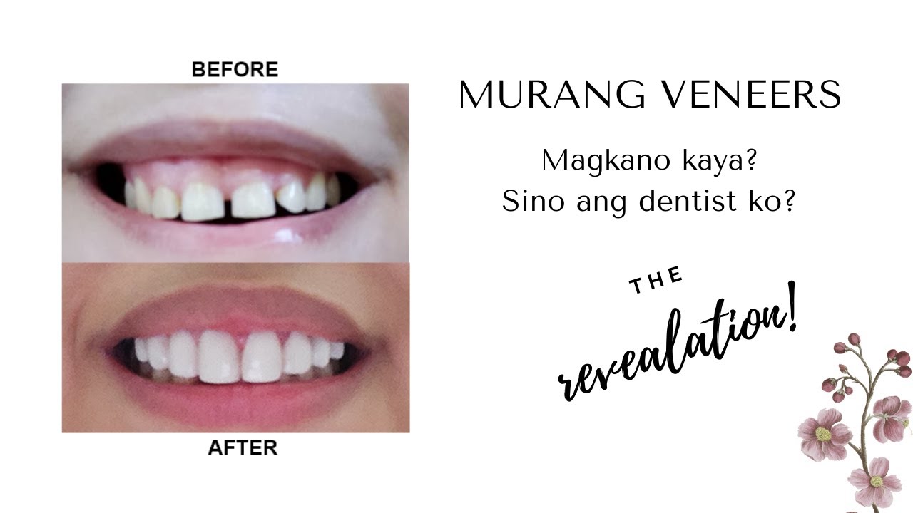 Best Veneers At Dental Clinic Sa Mandaue Cebu | Veneers Reviews & Feedback | Veneers Price Cebu