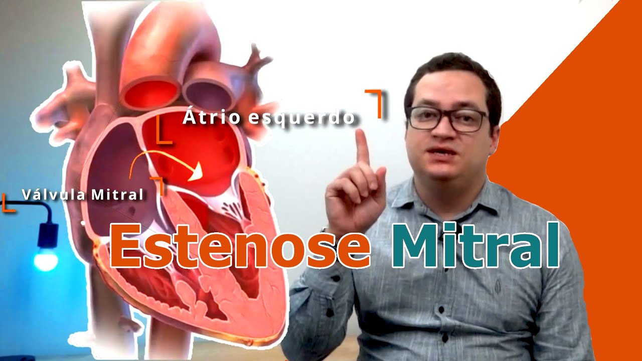 Estenose Mitral