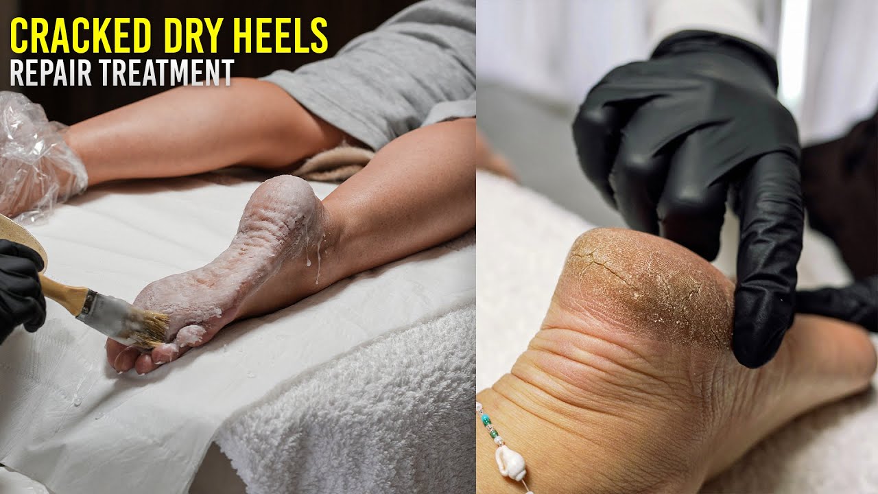 Fixing Dry Hard Cracked Feet With Paraffin Wax!