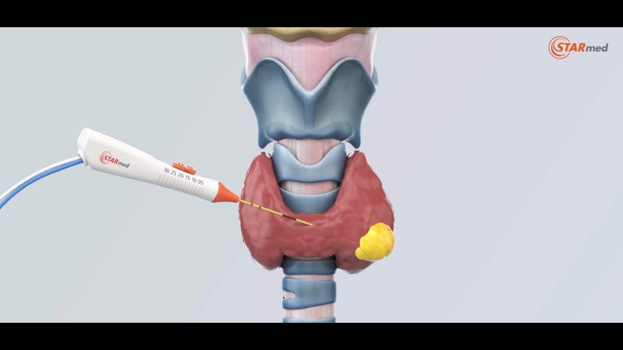 什么是甲状腺射频消融（Thyroid Radio Frequency Ablation RFA）?