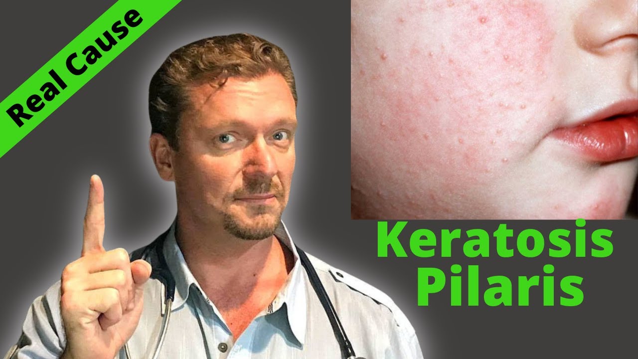 KERATOSIS PILARIS Fix? (Sign of Serious Condition?) Chicken Skin Cure