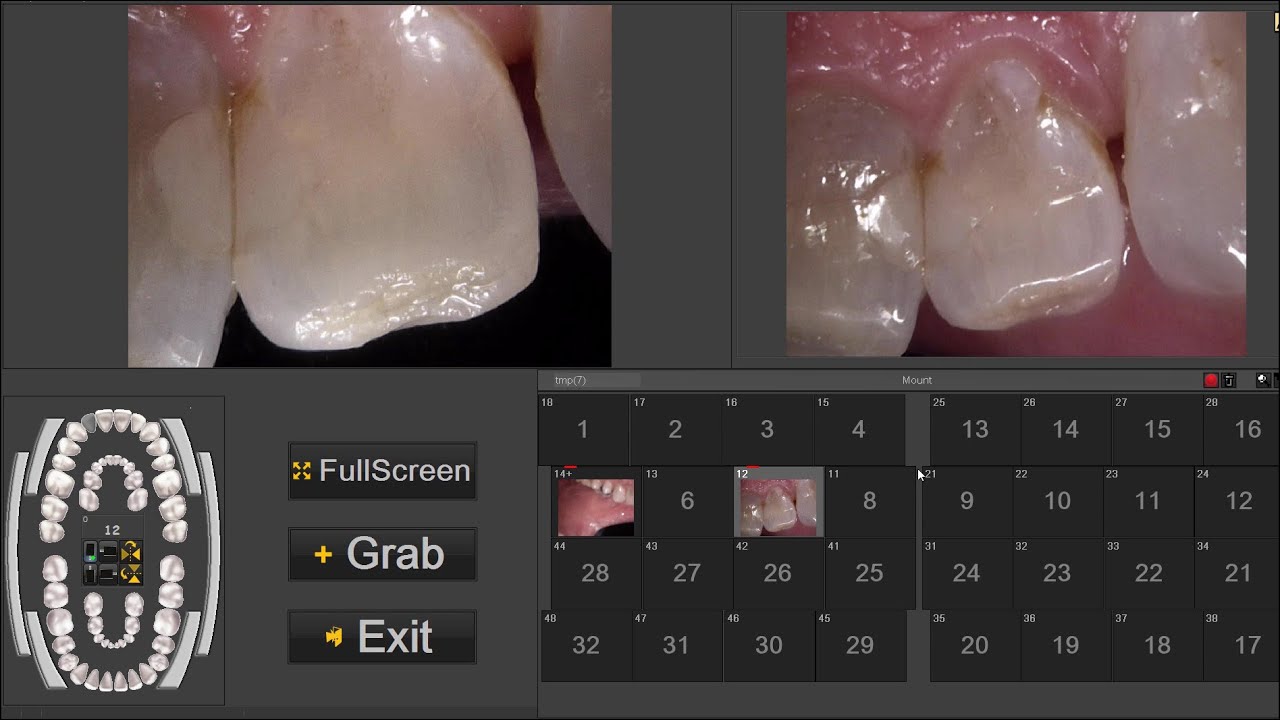 How to acquire & use intra-oral camera images in CADI