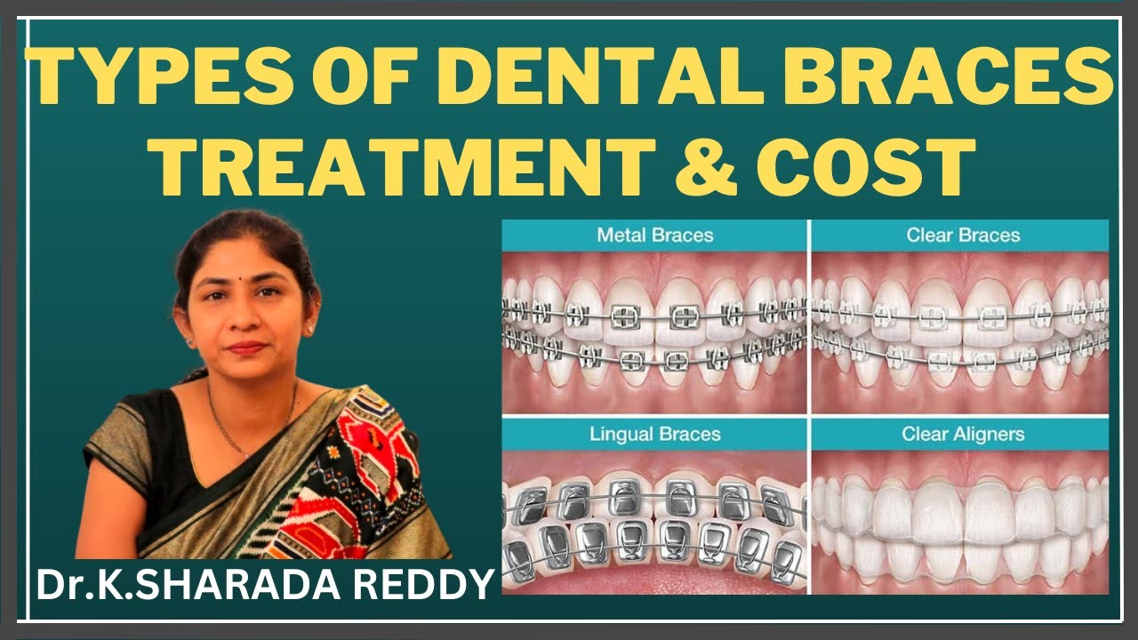 TYPES AND COST OF BRACES | DR.SHARADA REDDY #teeth #telugu #braces #aligner #invisaligndoctor #smile