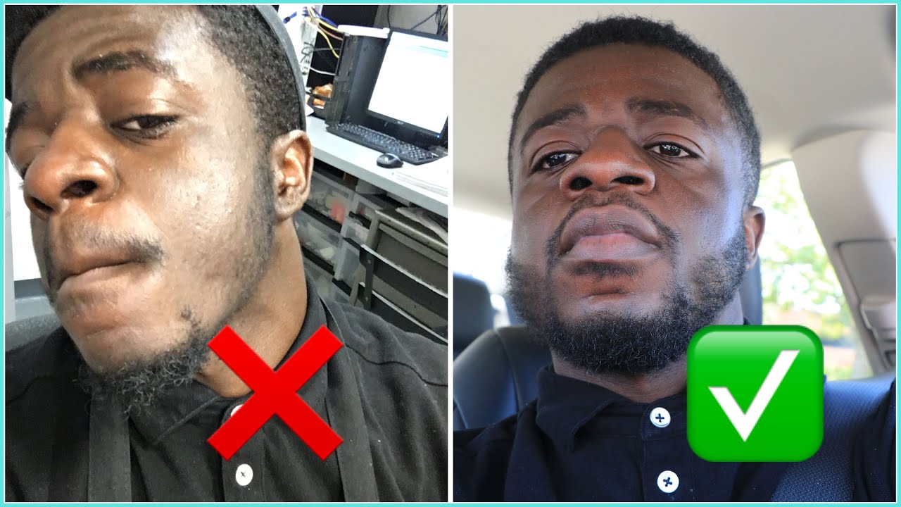8 Mistakes Minoxidil beginners Do!!