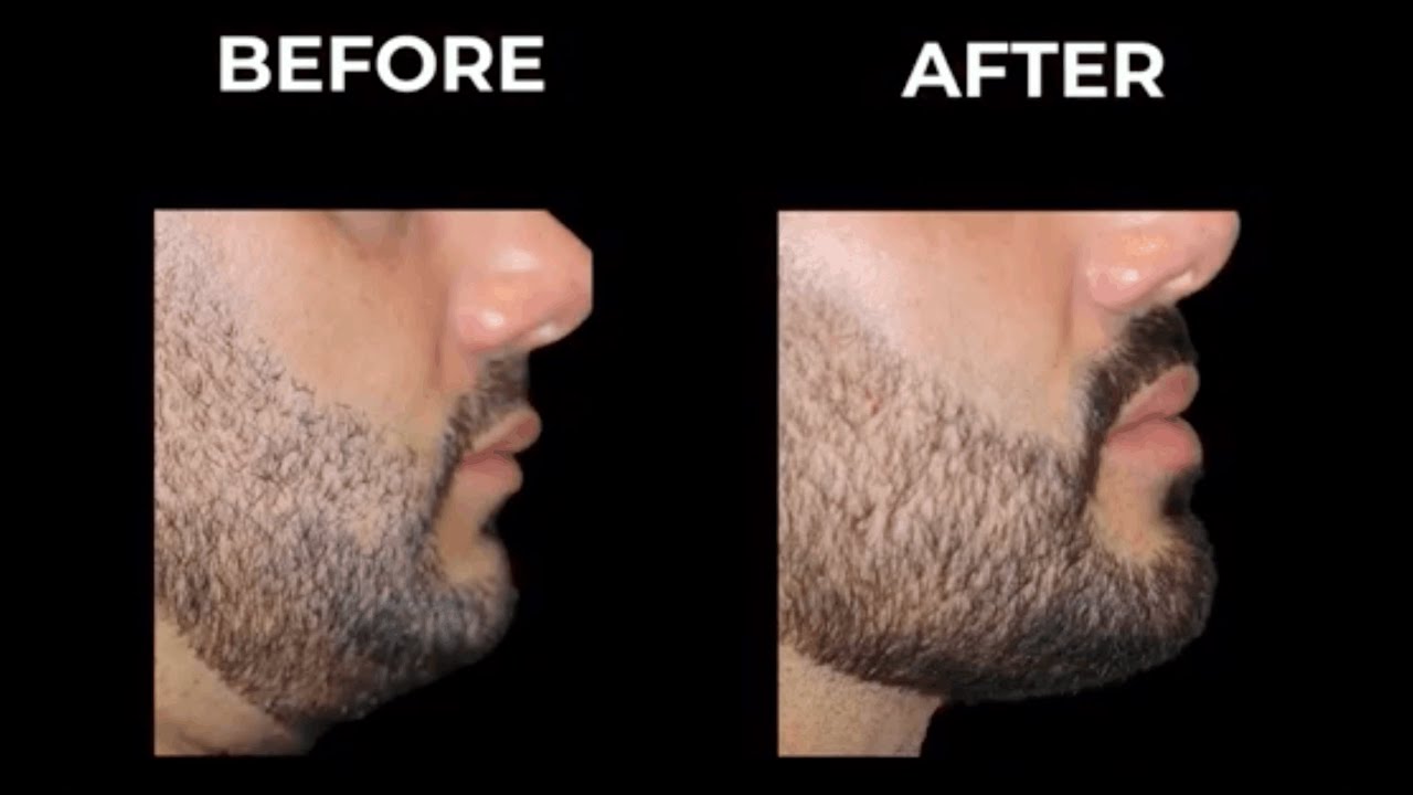 Jaw Align™ Transforms Faces without Surgery