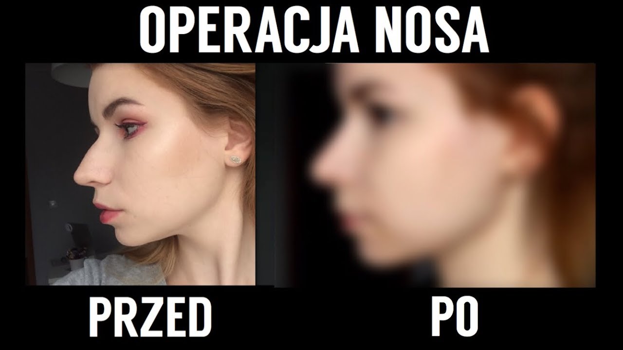 PRZED I PO OPERACJI NOSA (RHINOPLASTYKA) - NOSE JOB BEFORE  AND AFTER 👃