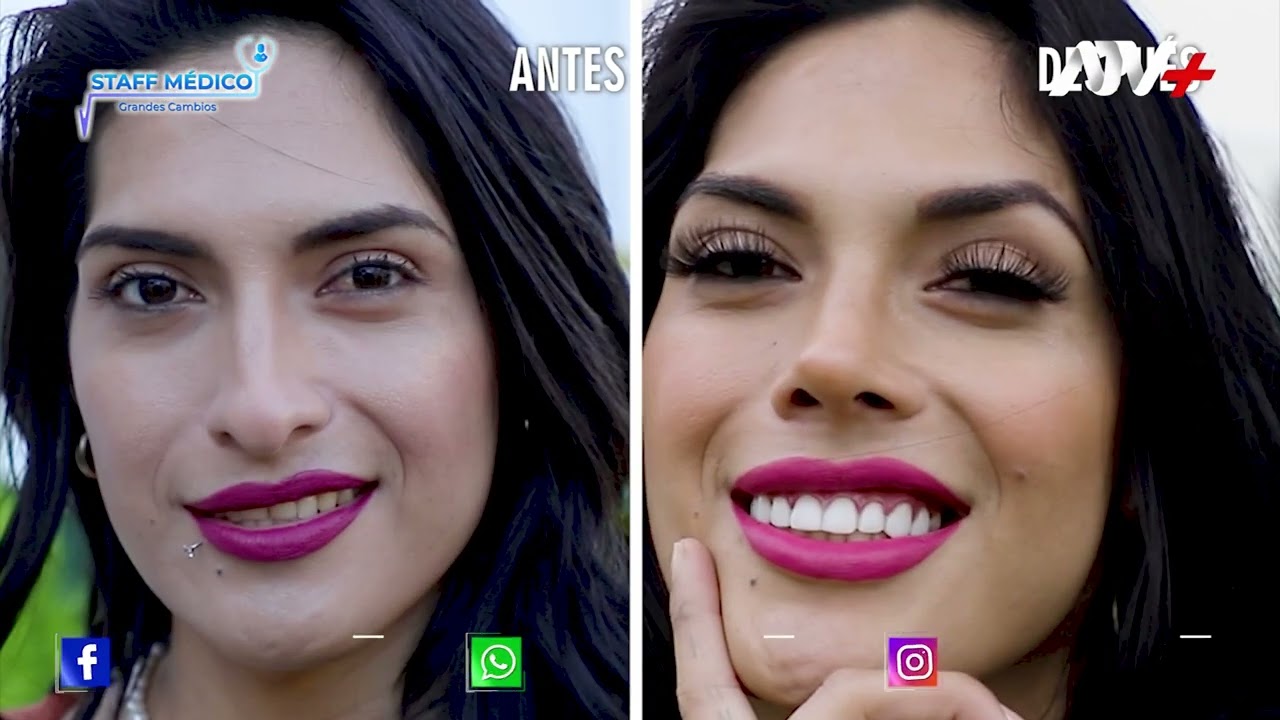 RINOSEPTOPLASTIA ULTRASÓNICA DE MILECHI | DRA KAREN VALVERDE