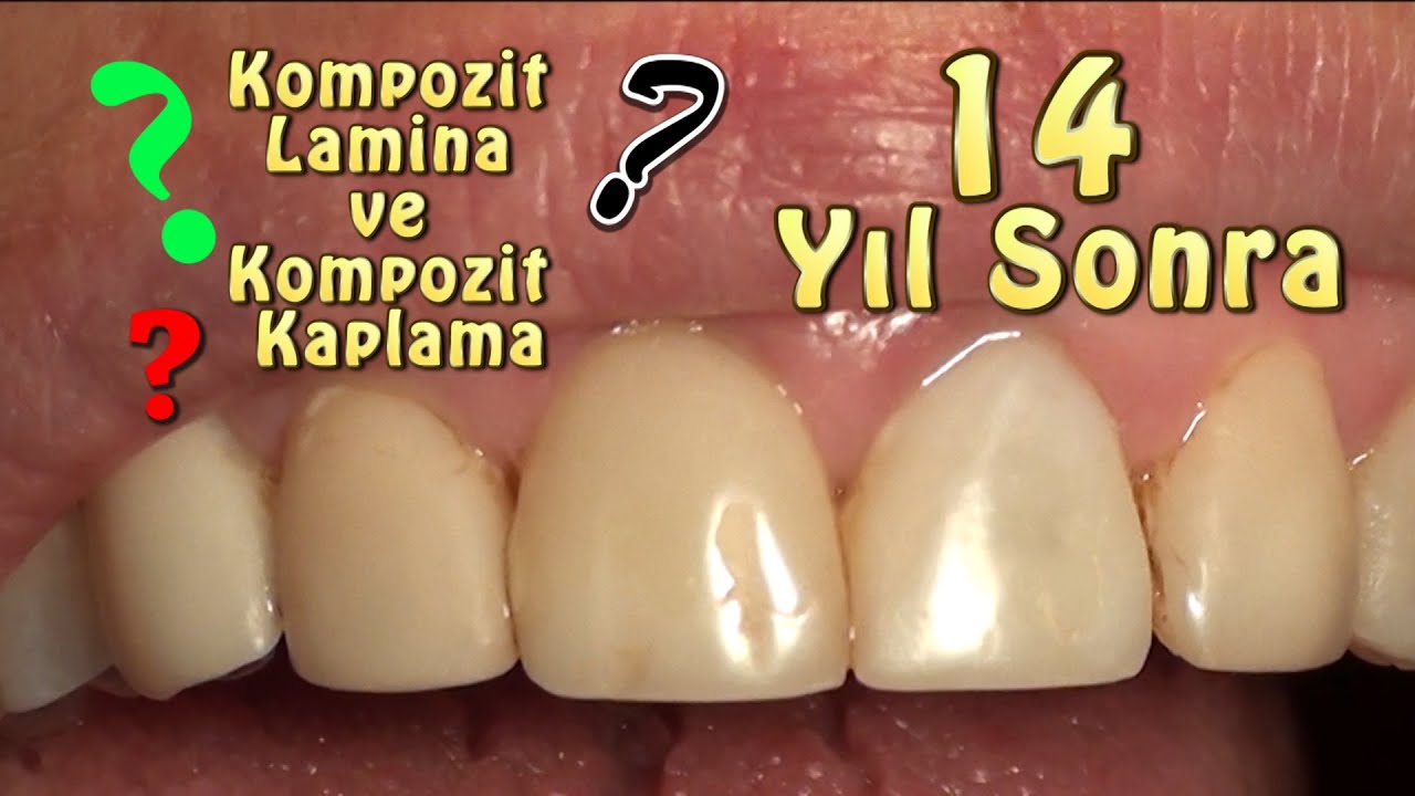 Kompozit lamina, Kompozit kaplama 14 Yıl Sonra