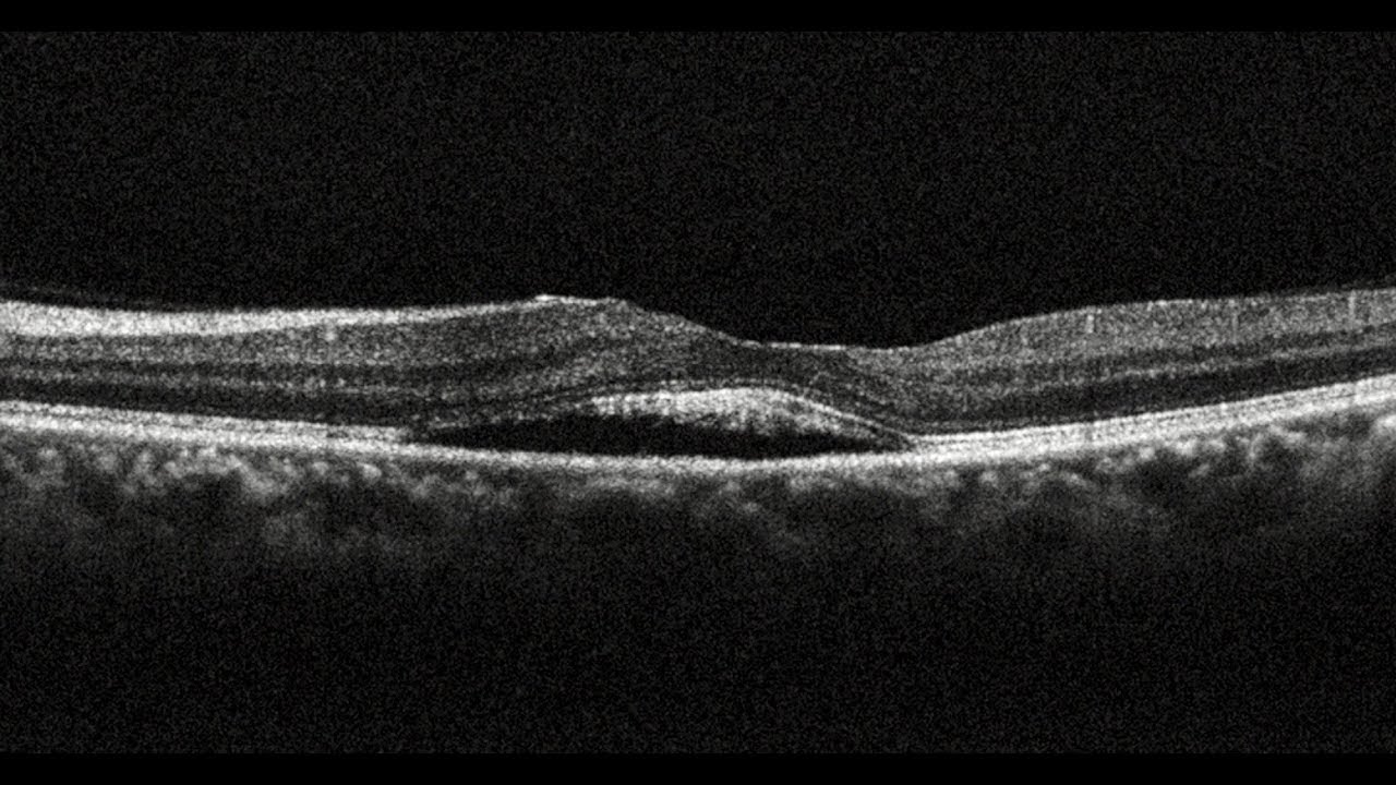 Photodynamic Therapy in Chronic Central Serous Chorioretinopathy | Retina Center Tijuana Mexico