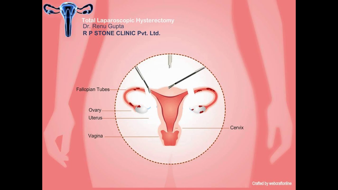 Animation of Total Laparoscopic Hysterectomy