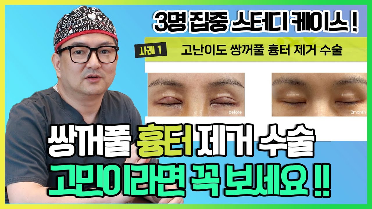 압구정 재봉틀의 고난이도 쌍꺼풀 흉터제거 3명 집중 케이스 스터디 #쌍꺼풀흉터제거 #눈재수술