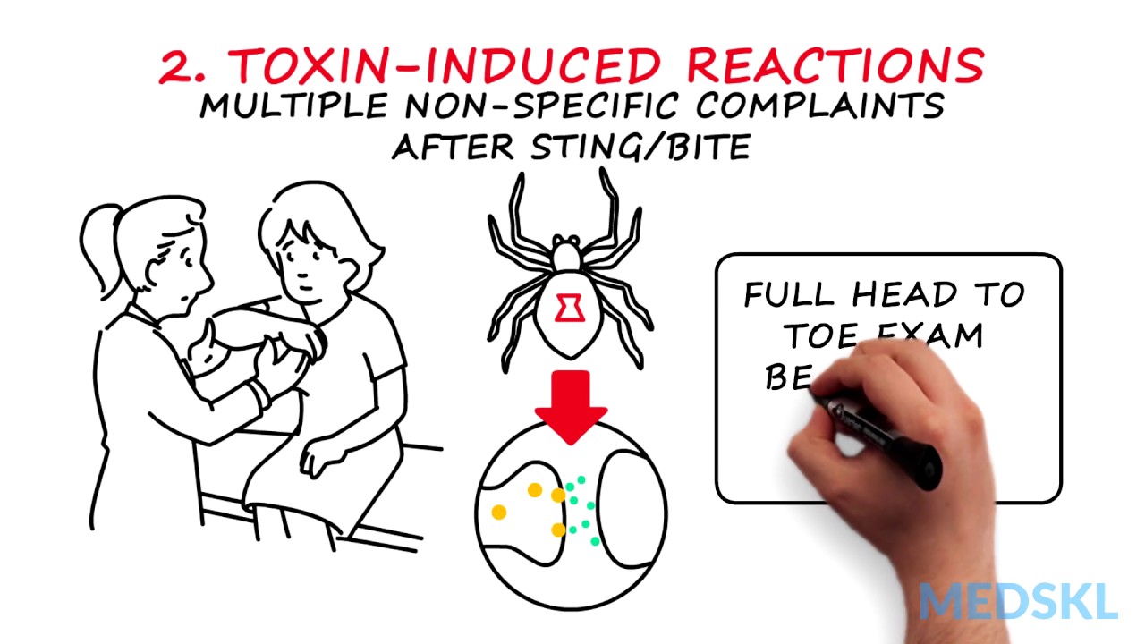 Emergency Medicine – Insect Stings and Bites: By Dersim Kaya M.D. & Abbas Husain M.D.