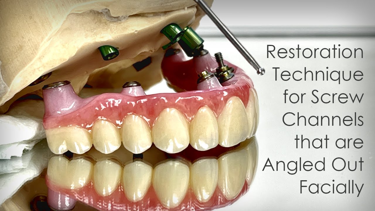 Excellent Restoration Technique for Angled Out Screw Channels