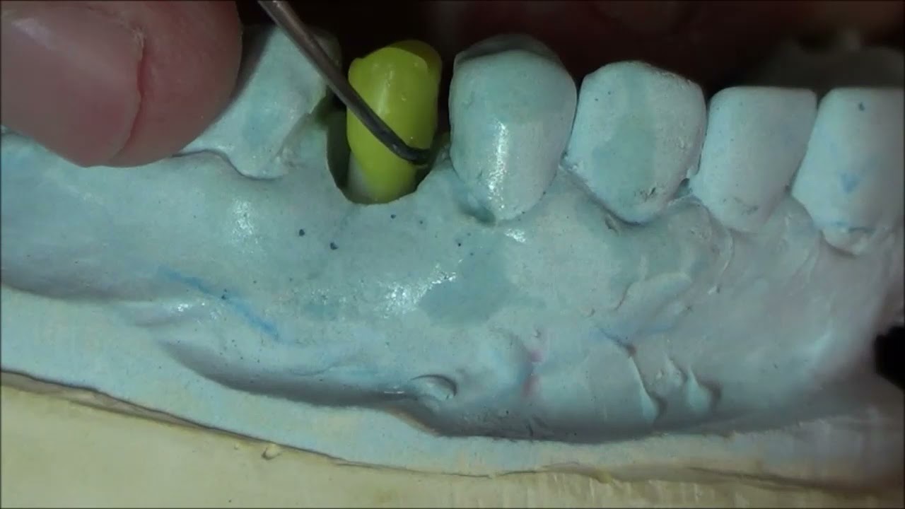 Enceramento de pré-molar superior sobre implante