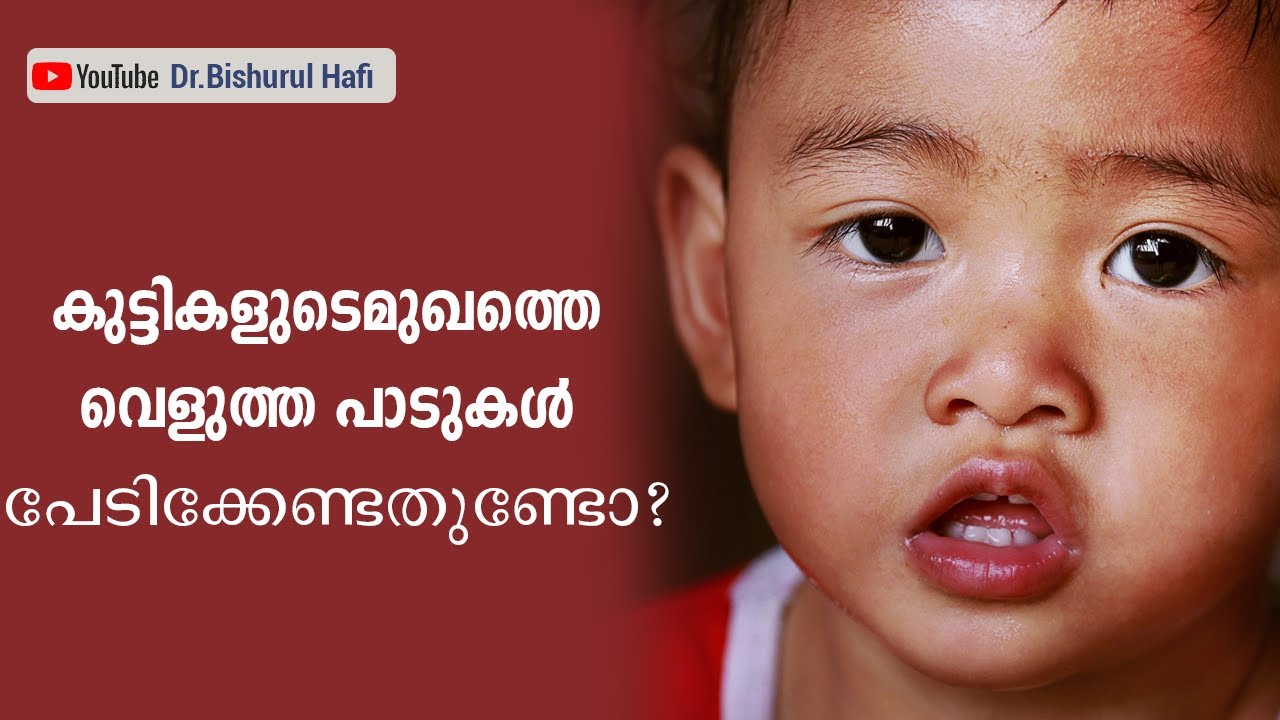 കുട്ടികളുടെ മുഖത്തെ വെളുത്ത പാടുകൾ പേടിക്കേണ്ടതുണ്ടോ? | Dr. Bishurul Hafi | Baby Skin care