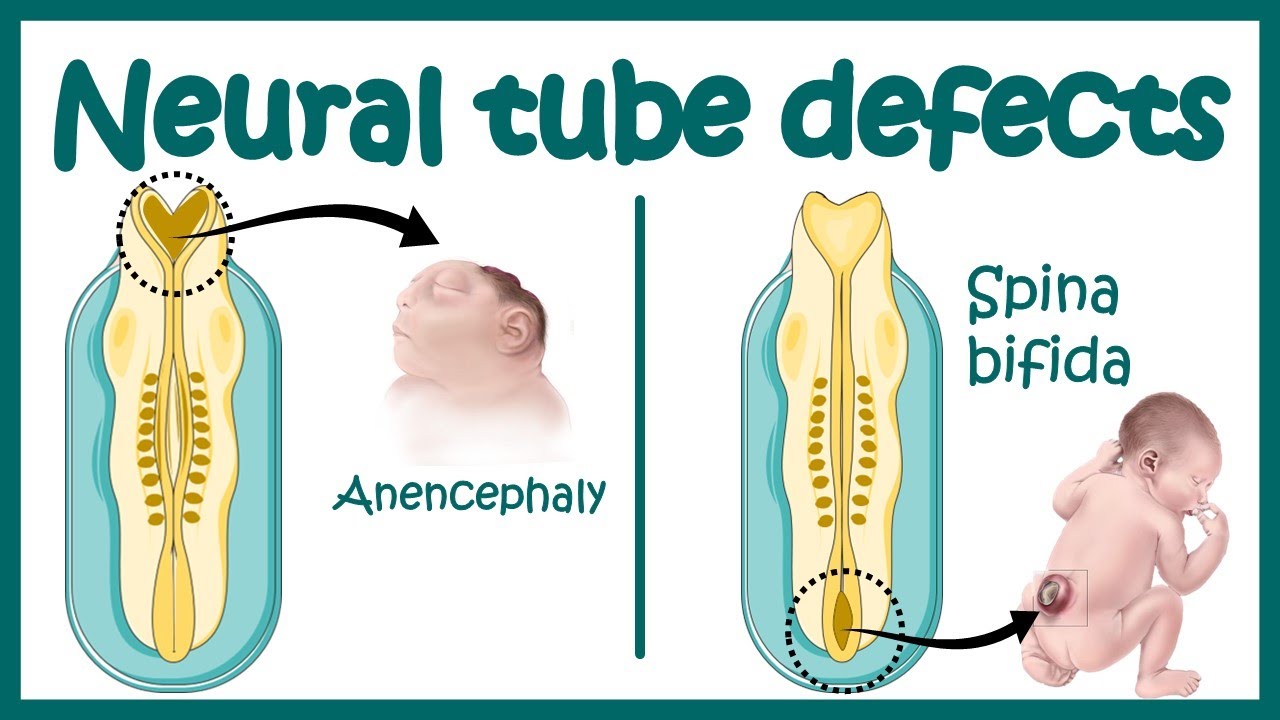 Neural Tube Defect - Overview | signs and symptoms of neural tube defect pathophysiology & treatment