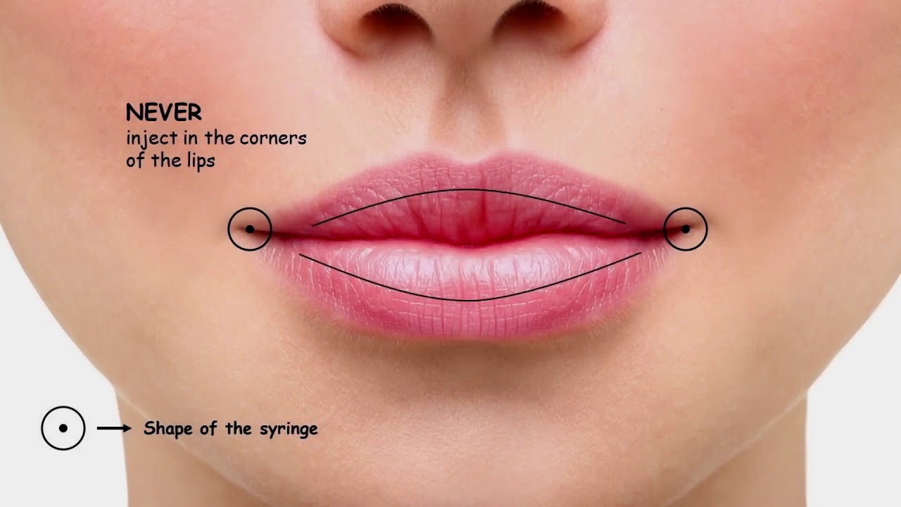 Lips by hyaluron pen free training
