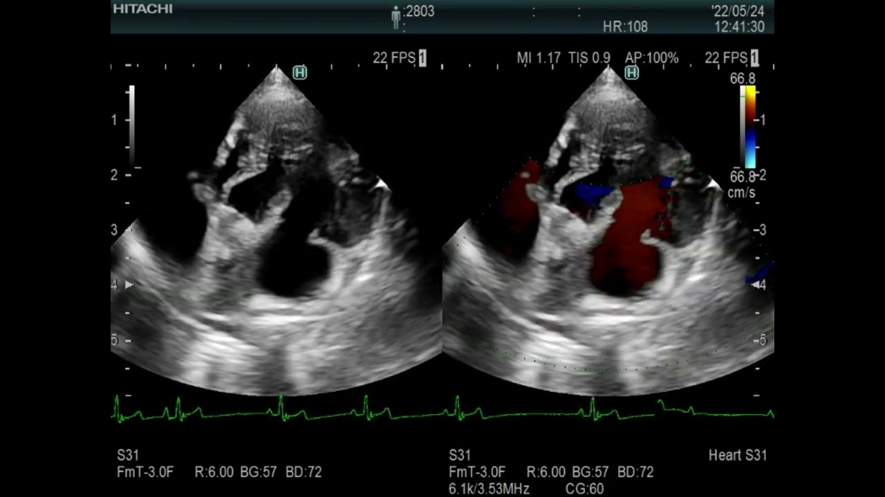 MR at the second degree  AV block of the Wenckebach type