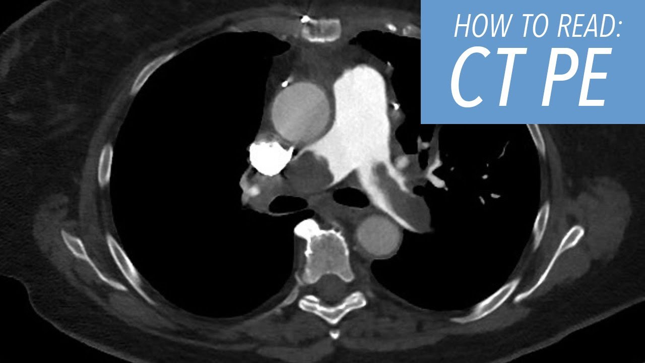How to Read a CTA of the Chest Pulmonary Embolism Protocol: A Beginner's Approach