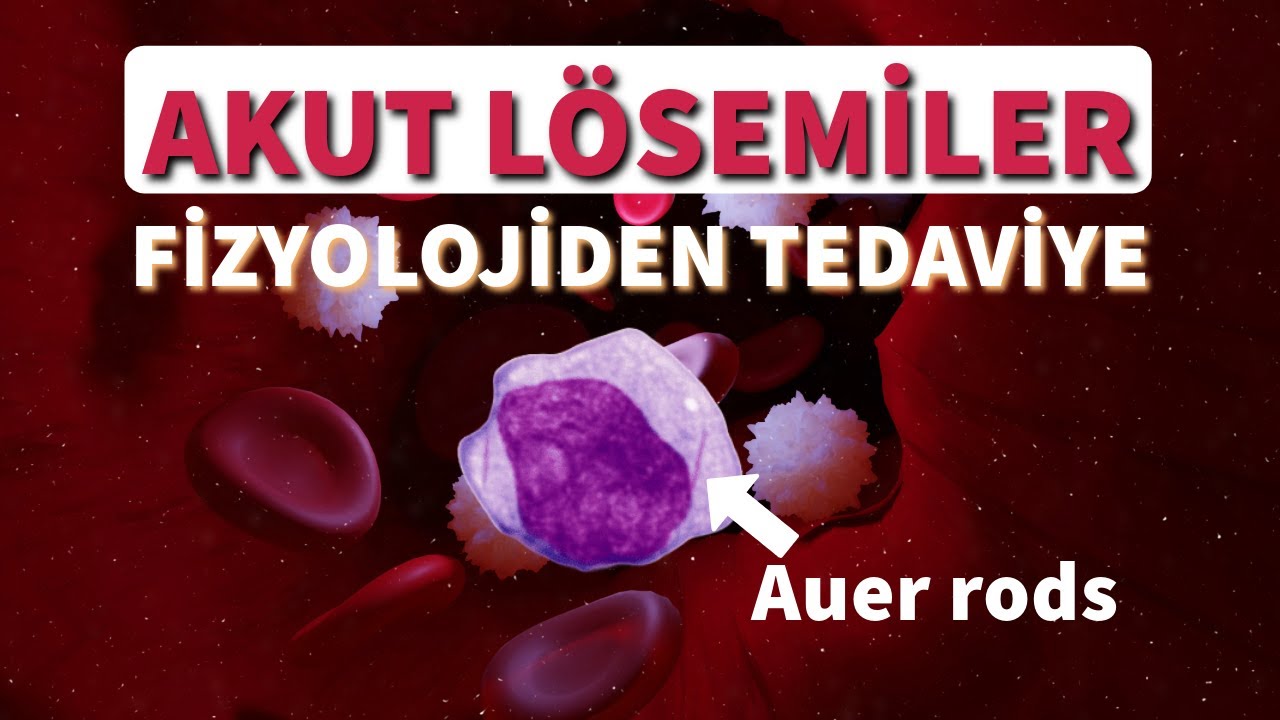 Akut Lösemiler | Fizyolojiden Tedaviye