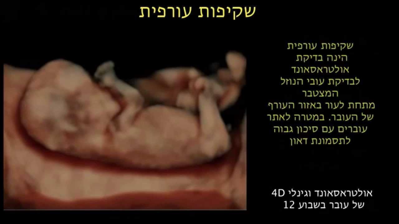 שקיפות עורפית