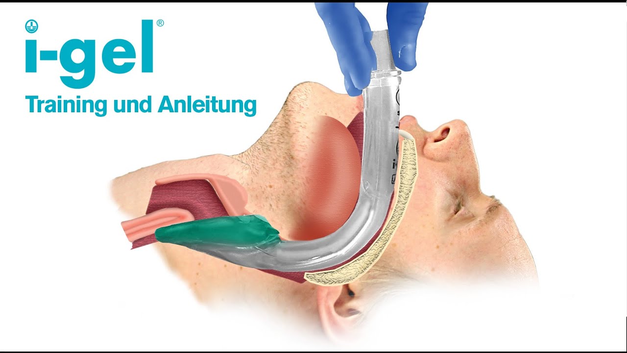 i-gel Training und Anleitung (Deutsch)